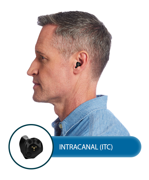 Intracanal_ITC.png